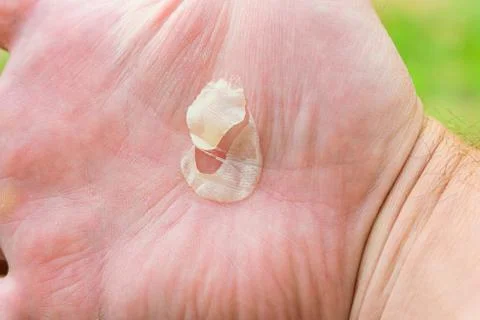 Large torn callus on palm surface of the hand close-up Stock Photos