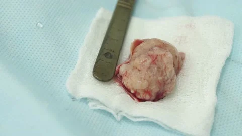 Large tumor removed from the brain, close-up Stock Footage 152944712