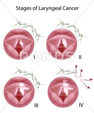 Laryngeal cancer Stock Illustration