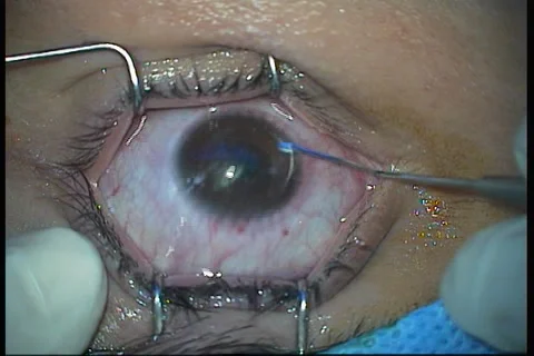 Laser beam of lasik machine on corneal stroma during lasik Stock Footage 284314846
