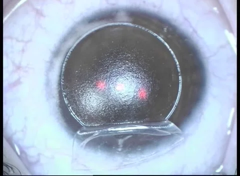 Laser beam of lasik machine on corneal stroma during lasik Stock Footage 284315568