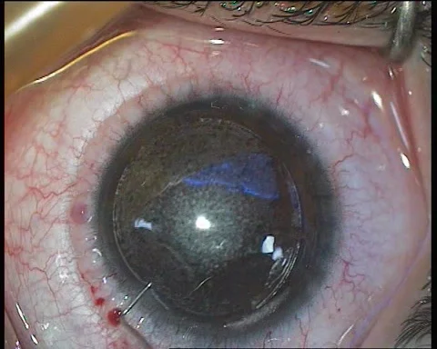 Laser beam of lasik machine on corneal stroma during lasik Video stock 284317393