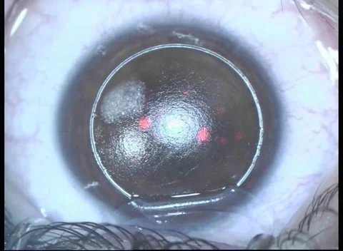 Laser beam of lasik machine on corneal stroma during lasik Stock Footage 284319425