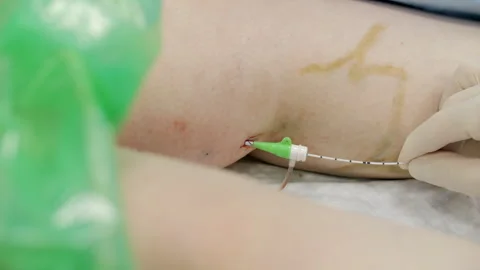 Laser catheter inserted for vein removal procedure Stock Footage 320739987