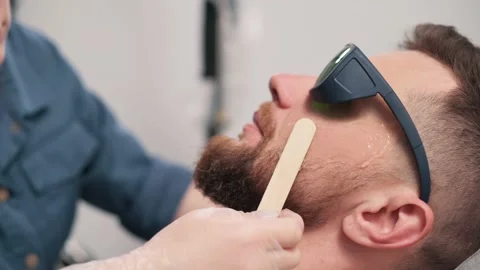 Laser depilation of beard contour. 스톡 동영상 196808185