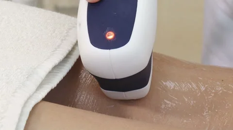 Laser depilation Stock Footage 47475946