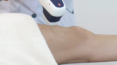 Laser depilation Stock Footage 47475955