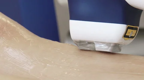 Laser depilation Stock Footage 47476073