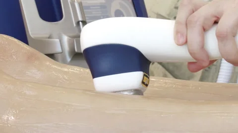 Laser depilation Stock Footage 47476132