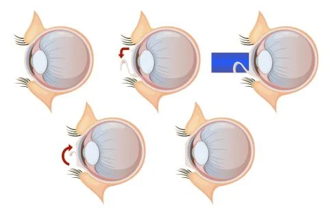 Laser eye correction イラスト素材