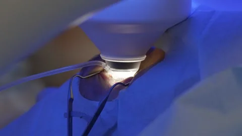 Laser eye correction using SMILE method 動画素材 159468973