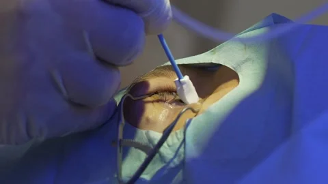 Laser eye correction using SMILE method. Doctor rubs eyes with cotton Video stock 159469015