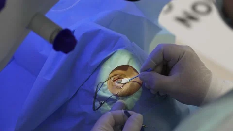 Laser eye correction using SMILE method. Doctor removes excess blood from the Video stock 159469227
