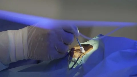 Laser eye correction using SMILE method. Doctor wipes cornea of the patient eye Video stock 162631493
