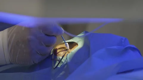 Laser eye correction using SMILE method. Doctor removes excess blood from eye. 動画素材 162631563