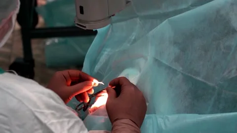 Laser eye surgery. Close-up eye surgery. Video stock 147092887
