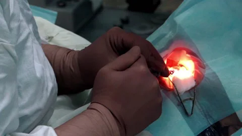 Laser eye surgery. Close-up eye surgery. Stock Footage 147093142