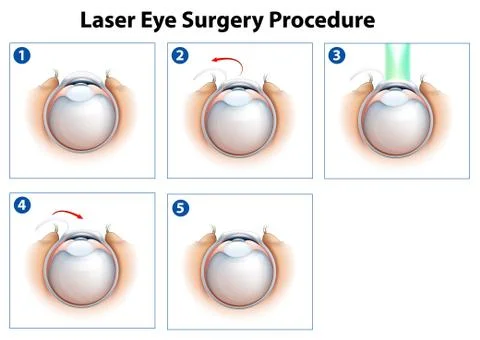 Laser Eye Surgery Procedure Stock Illustration
