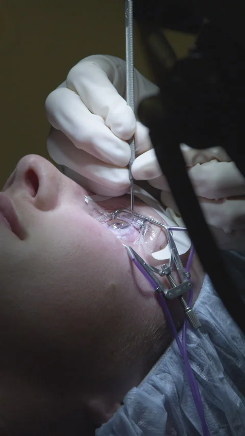 LASER EYE SURGERY STEP 7: Surgeon removes lasik corneal flap Stock Footage 287262114