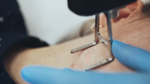 Laser face cleaning CO2 close-up Stock Footage 128762463