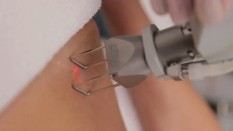 Laser grinding of stretch marks on the skin. Hardware cosmetology. The presence Stock Footage 227376782