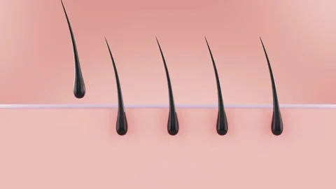 The Laser Hair Removal Process Stock Footage 305443440