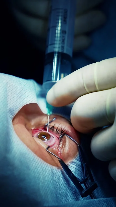 Laser modern cataract surgery. Stock Footage 310301249