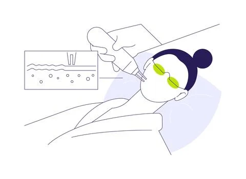 Laser peels abstract concept vector illustration. Stock Illustration