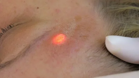 Laser procedure in the clinic.Cosmetologist performs hardware laser hair removal Stock Footage 169519073