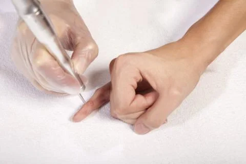 Laser ramoval of wart Stock Photos