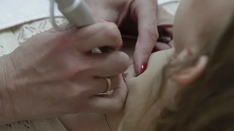 Laser removal of moles Stock Footage 73847572