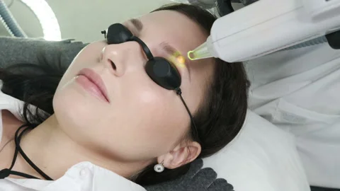 Laser removal of a permanent make-up on a face. Video stock 92332930