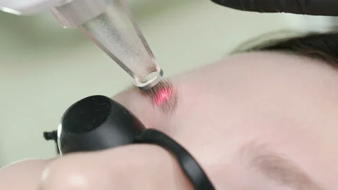 Laser removal of a permanent make-up on face. Stock Footage 92333122