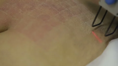 Laser removal of stretch marks on the abdomen Stock Footage 57900845