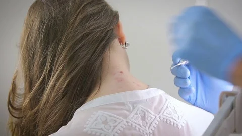 Laser removal of warts Stock Footage 70509795