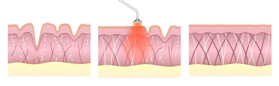 Laser skin resurfacing. Step by step illustration before and after. Illustrazione stock