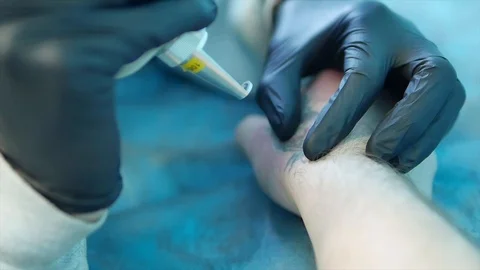 Laser tattoo mixing Stock Footage 101660971