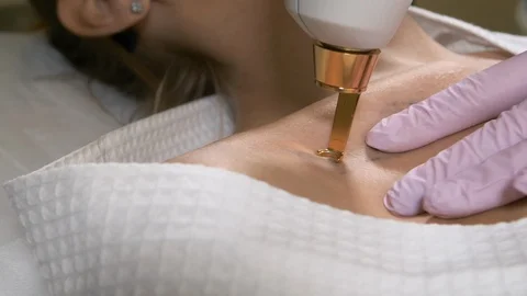 Laser tattoo removal Stock Footage 88170351