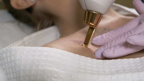Laser tattoo removal Video stock 88171610