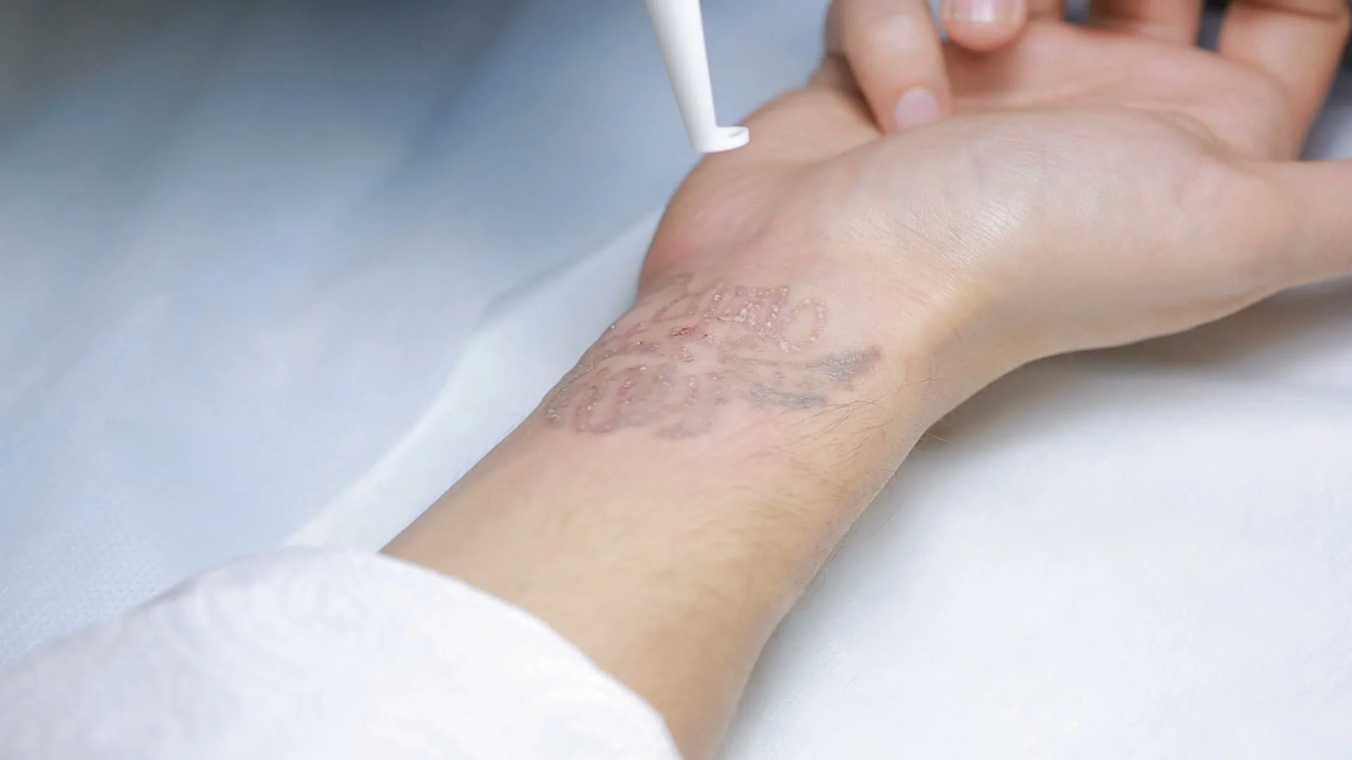 Tattoo Removal Cream Vs Laser Tattoo Removal