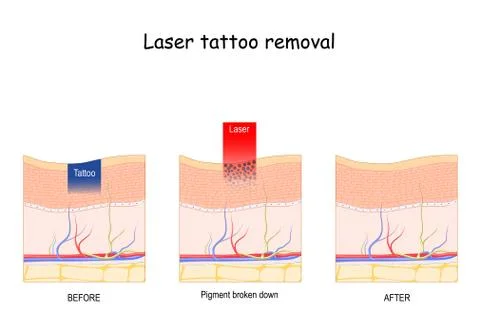 Laser tattoo removal. Stock Illustration