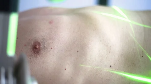 Laser treatment Stock Footage 108433085