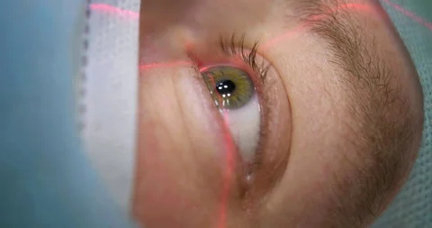 Laser vision correction. Close-up view of the patient's eye lying on the Stock Footage 154151541