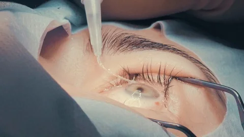 Laser vision correction. A patient in the operating room during ophthalmic Stock-Footage 102827676