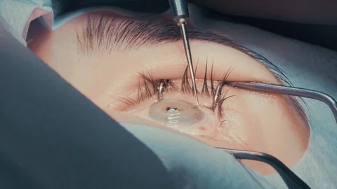Laser vision correction. A patient in the operating room during ophthalmic Stock Footage 102829052