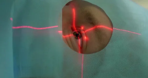 Laser vision correction, preparation for eye surgery. Close-up of patient under Stock Footage 155007999