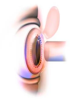 Lasik Eye: laser operation (here Lasik) to correct refractive errors. Copy... Foto stock
