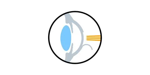 Lasik eye surgery 库存插图