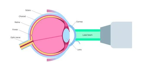 Lasik eye surgery 库存插图