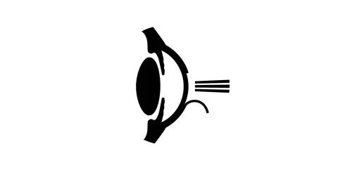 Lasik eye surgery 库存插图